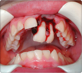 Completely Avulsed Teeth