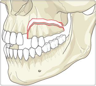 Step 1: Dentoalveolar Fractures or Displaced Teeth